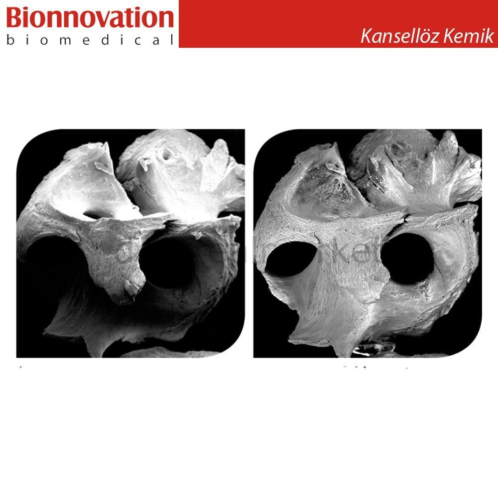 Bionnovation - Bonefill Prous (Cancellous) Bovine Graft - Xenograft - 2,5 gr (5cc)