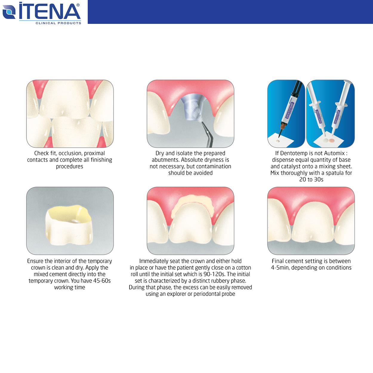 Itena - Dentotemp İntrokit Automix Implant Cement - 1x6 gr