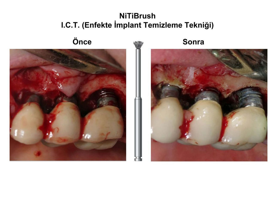 Dentkonsept - Niti Brush OMEGA Periimplantitis Bur