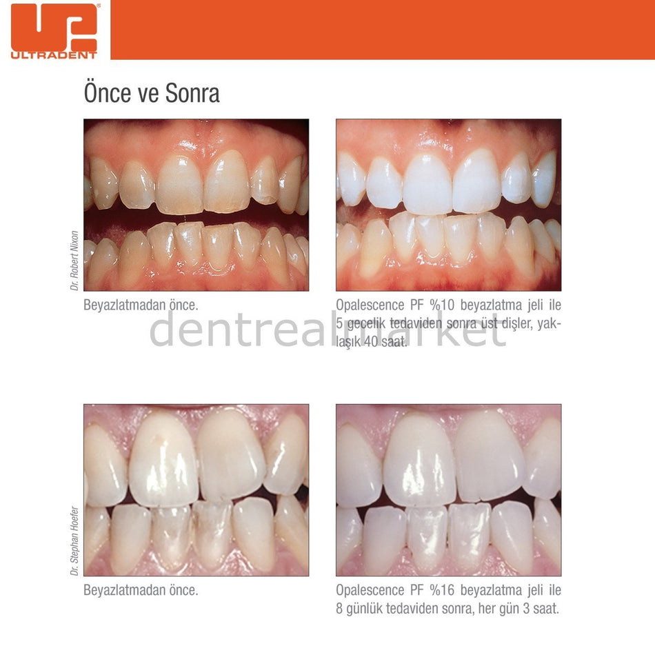 Ultradent - Opalescence Tooth Whitening - Carbamide Peroxide - Teeth Whitening at Home