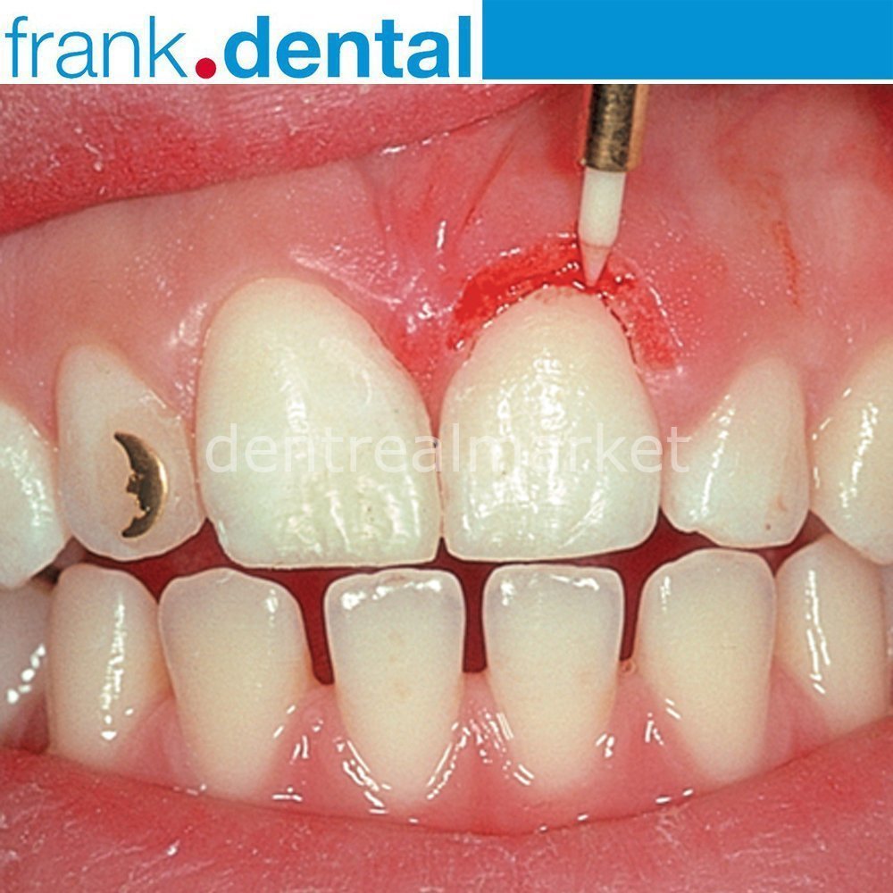 Frank Dental - Soft Tissue Gingiva Trimmer Burs - Ceramic Gingiva Bur - GT135 - STT250