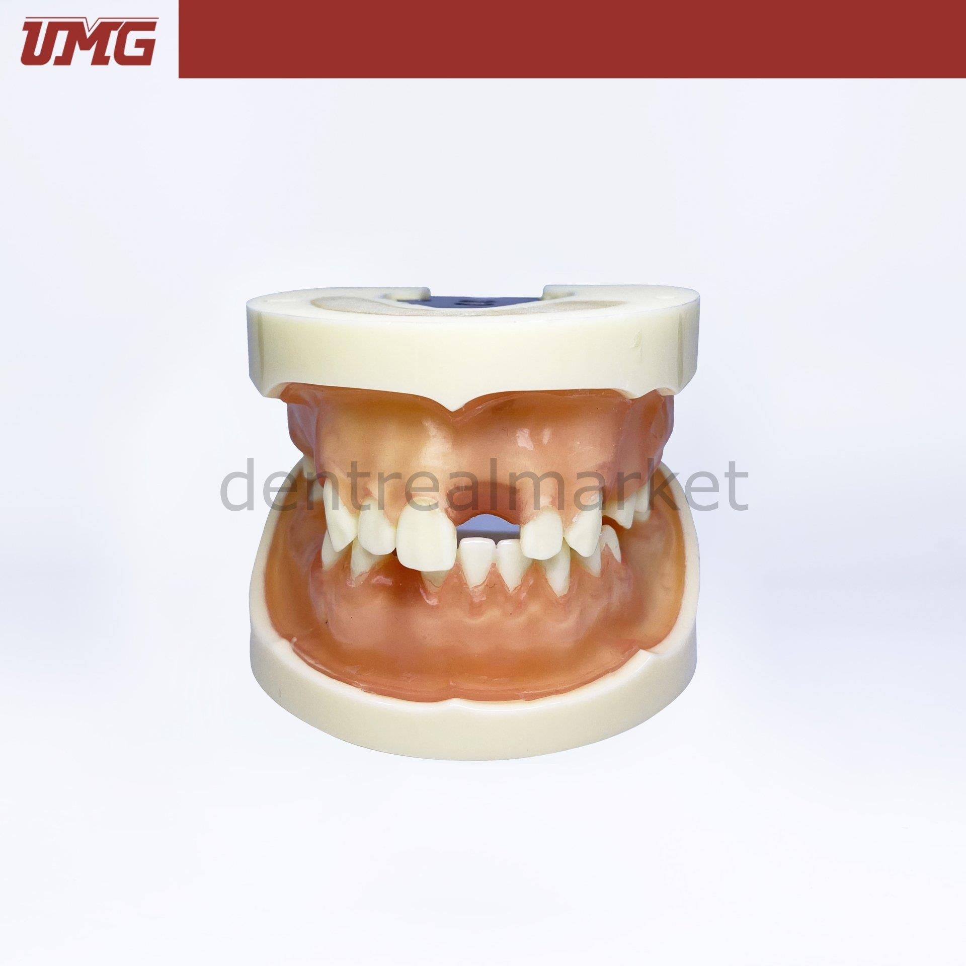 Umg Dental - Umg Model Implant Training Model Upper - Lower Jaw - UM - 2002