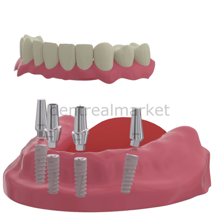 X - Gate Dental - X3 Internal Hex Implant Body - Diameter 3.3 mm - Single Platform Implant