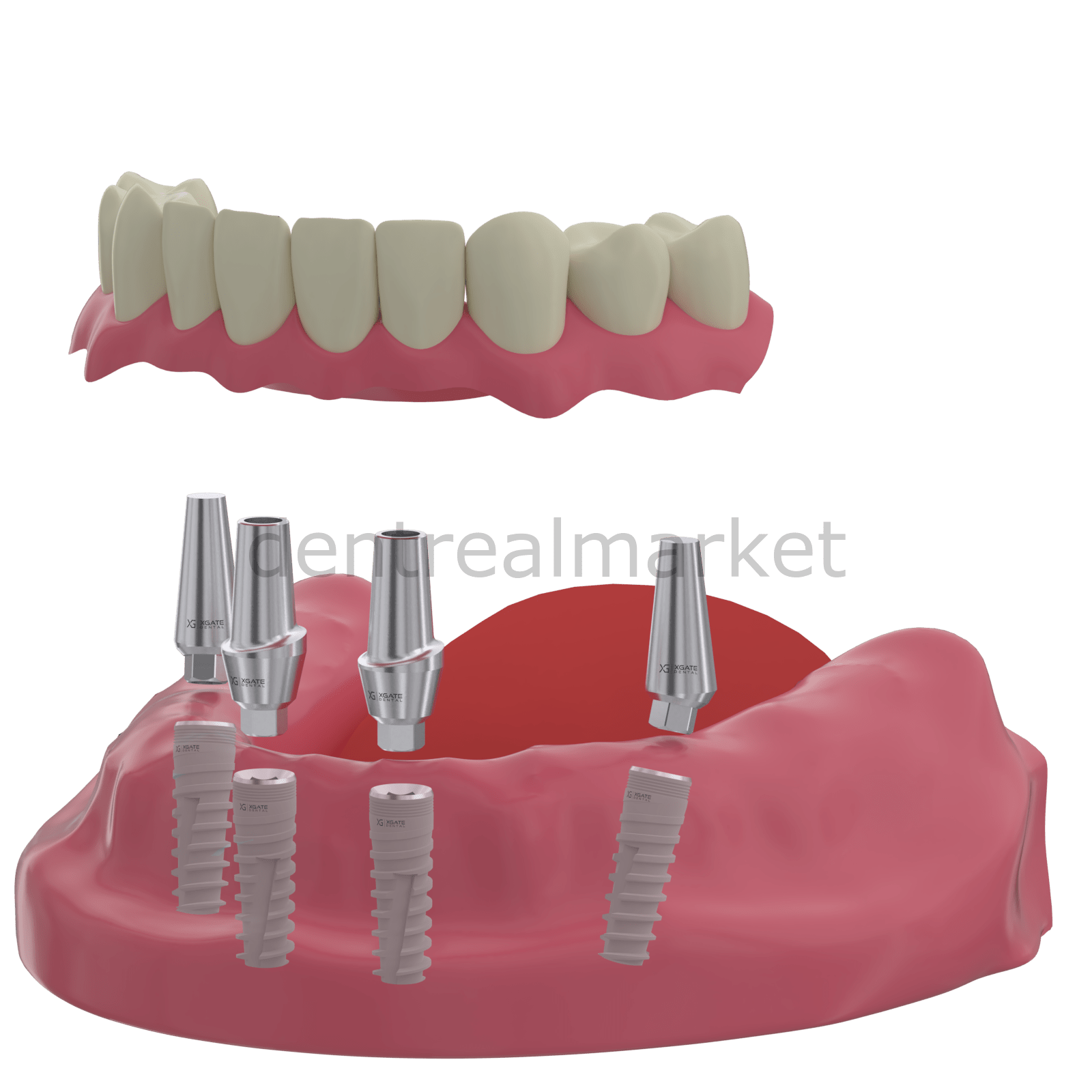 X - Gate Dental - X3 Internal Hex Implant Body - Diameter 5.0 mm - Single Platform Implant