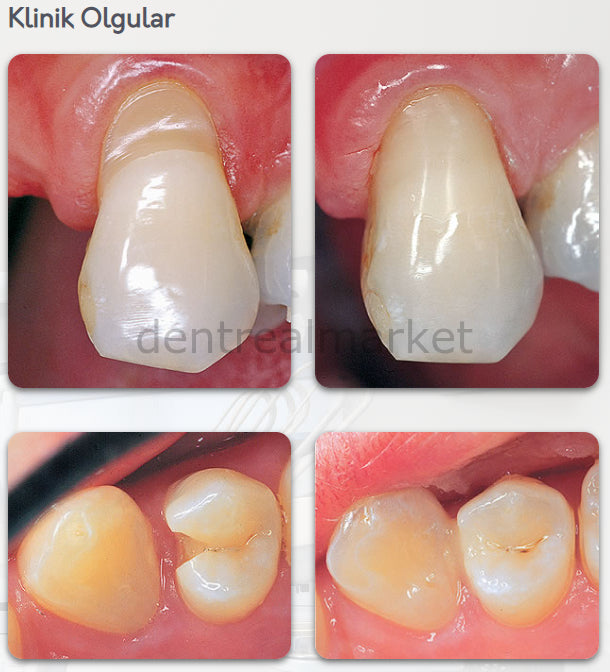 Flow-It ALC Flowable Composite - 6x1,5 gr - A2