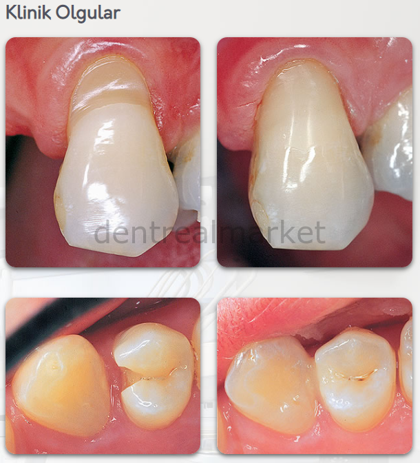 Flow-It ALC Flowable Composite Refil