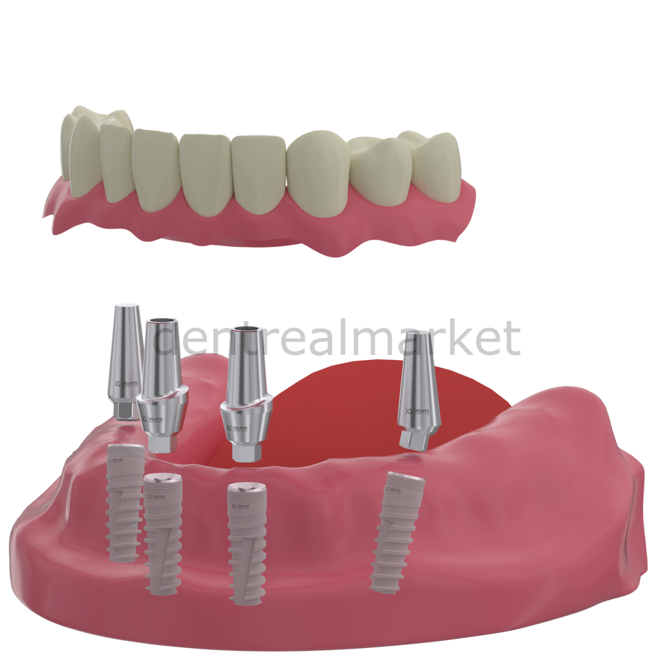 X3 Internal Hex Implant Body - Diameter 3.3 mm - Single Platform Implant